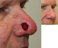 45-54 year old man treated with Mohs Surgery