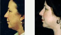 51 Year Old Woman Treated With Facelift Before By Dr. Robert H. Hunsaker, MD, Miami Plastic Surgeon
