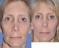 53 year old female who underwent full face fat transfer