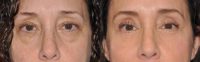 45-54 year old woman treated with Eye Bags Treatment