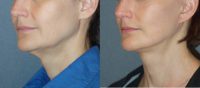 45-54 year old woman treated with s Mini Facelift with Necklift and Fraxel Dual Laser Treatment