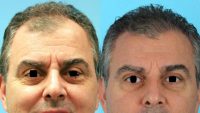 45-54 year old man treated with ARTAS Robotic Hair Transplant