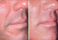 54 year old man treated with Restylane® for nasolabial folds and wrinkles