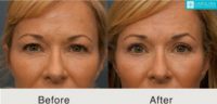 45-54 year old woman treated with Brow Lift