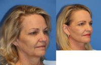 54 year old woman treated with Facelift