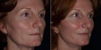 54 Year Old Woman Treated With Facelift Before By Doctor Bao L. Phan, MD, Honolulu Plastic Surgeon