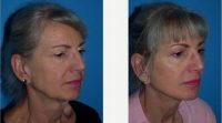 55 Year Old Woman Treated With Facelift Before By Dr Kyle S. Choe, MD, Virginia Beach Facial Plastic Surgeon