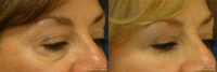 55 year-old woman underwent Restylane injections to blend away eyebags and give a virtual cheeklift.