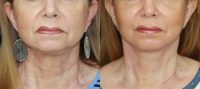 55-64 year old woman treated with Lower Face Lift