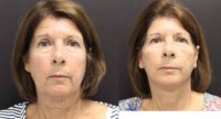 55-64 year old woman treated with Mini Facelift