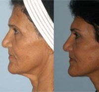 57 year old woman treated with Forehead Lift