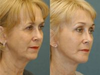 55-64 year old woman treated with Chin Implant