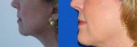 55-64 year old woman treated with Natural Facelift (in-office procedure)
