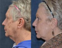 55-64 year old woman treated with Chemical Peel