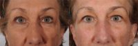 58 - 68 year old woman treated with Lower Eyelid Surgery