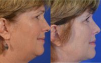58 year old woman post Facelift, Upper Eyelid Blepharoplasty and Fat Transfer to the Cheeks