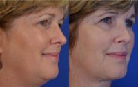 58 year old woman post Facelift, Upper Eye Lid Blepharoplasty and Fat Transfer to the cheeks