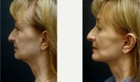 58 Year Old Woman Treated With Facelift Before With Dr. Jeff Angobaldo, MD, Dallas Plastic Surgeon