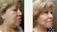 58 Year Old Woman Treated With Facelift Before With Dr. Peter Chang, MD, Houston Plastic Surgeon