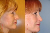 59 year old female desires change in nasal appearance