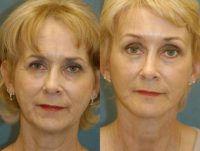 55-64 year old woman treated with Chin Implant