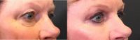 55-64 year old woman treated with Quad Blepharoplasty or Eyelift