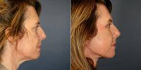 59 Year Old Woman Treated With Facelift Before With Doctor Steve Laverson, MD, San Diego Plastic Surgeon