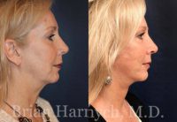 59 year-old female before and after Facelift and Neck Lipo