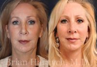 59 year-old female before and after Facelift and Neck Liposuction.