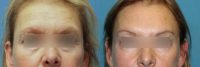 55-64 year old woman treated with Botox