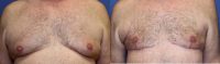 60 year old man with a Male Breast Reduction