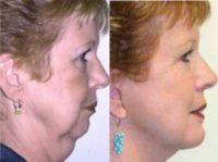 60 year old woman treated with Facelift