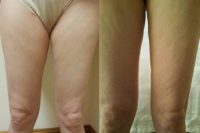 60  year old woman treated with Cellulaze