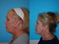 55-64 year old woman treated with Ultherapy.