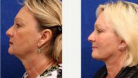 60 Year Old Woman Treated With Facelift Before With Doctor Ivan Wayne, MD, Oklahoma City Facial Plastic Surgeon