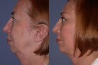 55-64 year old woman treated with Facelift and chin implant