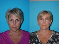 55-64 year old woman treated with Facelift, browlift, lower eyelid and fat augmentation.