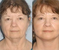 61 year old woman treated with Facelift