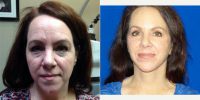 61 Year Old Woman Treated With Facelift Before With Doctor Barbara L. Persons, MD, FACS, Bay Area Plastic Surgeon