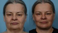 55-64 year old woman treated with Deep Plane facelift