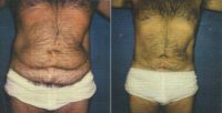 62yo who Dr Prysi performed ultrasonic liposuction on the abdomen and hips