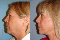 63 year old female desires facial rejuventation