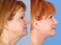 55-64 year old woman treated with Neck Lift