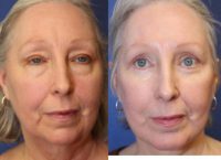 63 year old woman with a Facelift