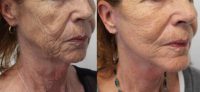 55-64 year old woman treated with Limited-incision lower facelift