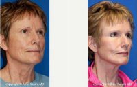 63 Year Old Woman Treated With Facelift Before With Dr Amir M. Karam, MD, San Diego Facial Plastic Surgeon