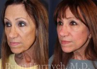 63 year-old female before and after Facelift, Autologous Fat Transplantation and Neck Liposuction.
