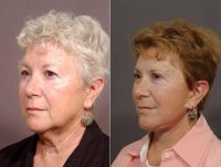 64 Year Old Female Before By Doctor Vito C. Quatela, MD, Rochester Facial Plastic Surgeon