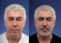 64 year old man treated for Facial Rejuvenation