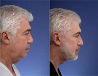 64 year old man treated with Facial Rejuvenation